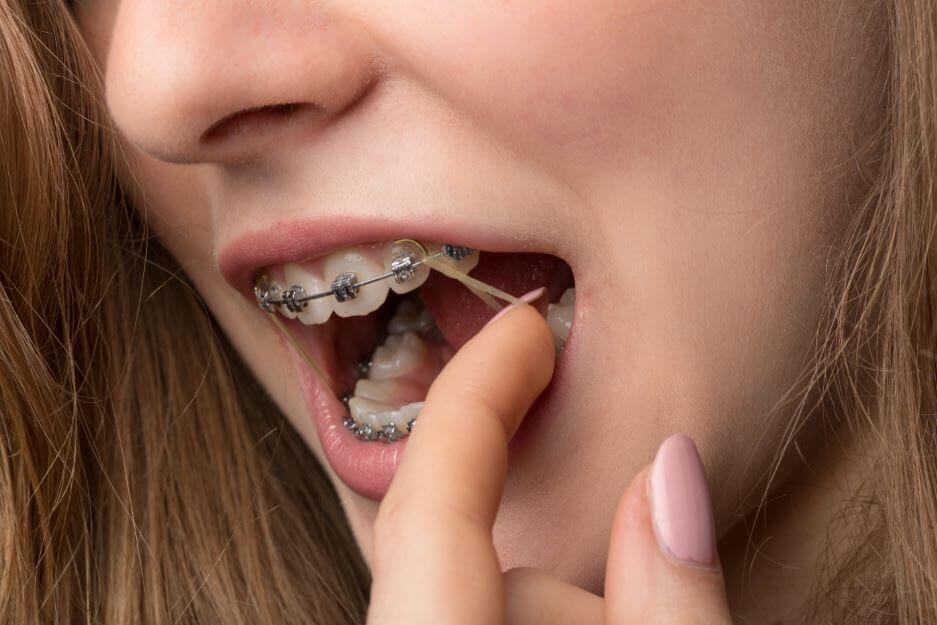 A girl with traditional braces picks at her orthodontic rubber bands.