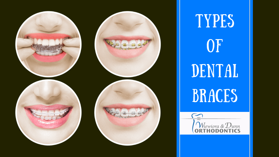 Types of Dental Braces Image