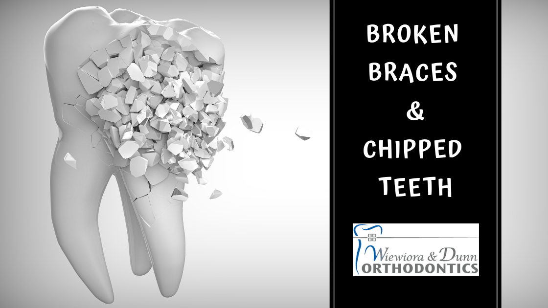 Broken teeth, chipped teeth, broken teeth with braces,