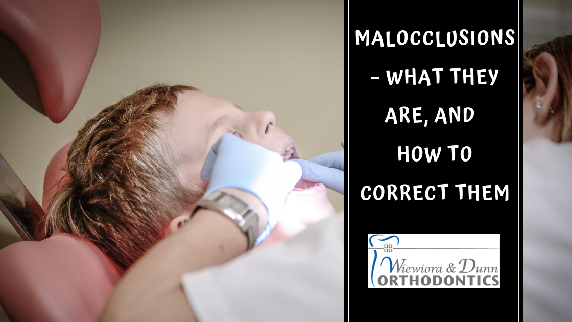 What is a Malocclusion